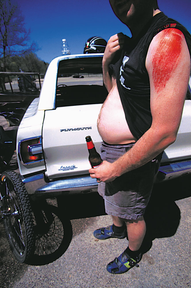 Left view of a person with a scraped shoulder, holds their shirt to show their belly, with beer in hand, next to a car